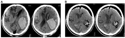 Recent Updates in Neurosurgical Interventions for Spontaneous Intracerebral Hemorrhage: Minimally Invasive Surgery to Improve Surgical Performance